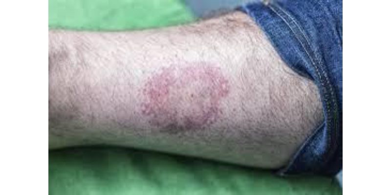 Possible symptoms of tick bite diseases